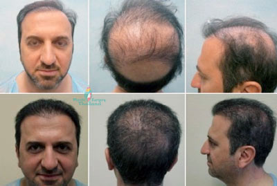 parham-hair-regeneration-bangkok-before-after-thailand-fut-fue-neograft-stemcell