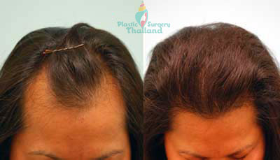 susan-hair-transplants-bangkok-before-after-thailand-fut-fue-neograft-stemcell
