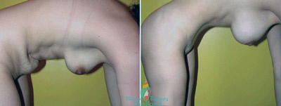 Thai-Mommy-makeover-before-after-pictures-thailand-(1)