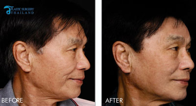 male-thermage-cpt-before-after-bangkok-thailand
