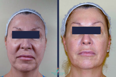 thermage-before-after