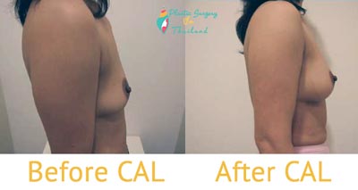 CAL-breast-bangkok-natural-breast-augmentation-before-after