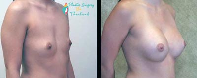 cal-stem-cell-enriched-bangkok-thailand-before-after-picture