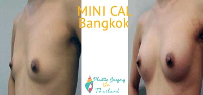mini-cal-stem-cell-enriched-bangkok-before-after-picture