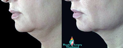 ulthera-before-after-results-bangkok-thailand-no-surgery-facelift-necklift