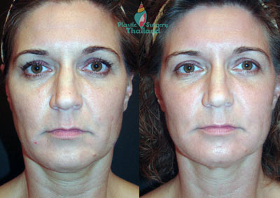 ulthera-ultrasonic-bangkok-thailand-no-surgery-facelift-before-after-ruthy