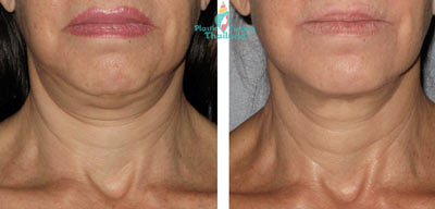 ultherapy-facelift-before-after-nancy-2013