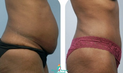 bodytite-abdomen-laura-before-after-surgery-bodytite