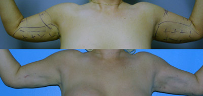 invasix-bodytite-arms-before-after-surgery-bodytite