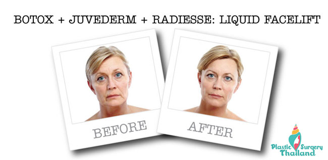 liquid-facelift-thailand-before-after-prices