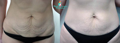 stomach-bodytite-loren-before-after-picutre-surgery-bodytite-thailand