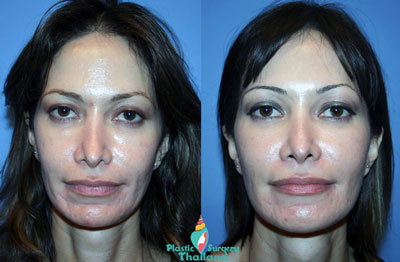 susan-liquid-facelift-phuket-thailand-before-after-prices