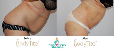 upper-lower-abs--bodytite-shiela-before-after-picutre-surgery-bodytite-thailand