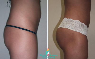 Brazilian Lift for Natural Butt Augmentation