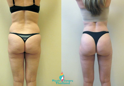 brazilian-buttlift-bangkok-back-jennifer-before-after