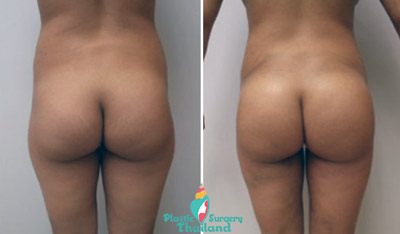 brazilian-fat-lipotransfer-butt-thailand-pictures