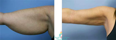 Arm-Liposuction-bangkok