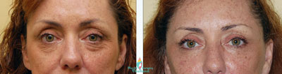 blepharoplasty-thailand