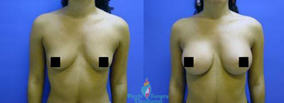 breast-augmentation-thailand-before-and-after-2014