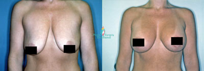 breast-lift-augment-before-after-thai-medical