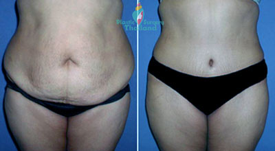 mini-abdominoplasty-tummy-tuck-thailand-2014