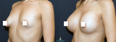 botched-breast-augmentation-revision-before-after-bangkok
