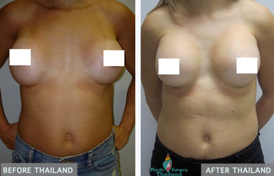 breast-revision-surgery-bangkok-thailand-before-after