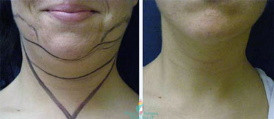chin-liposuction-smartlipo-laser-liposuction-before-after