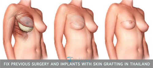 revision-reconstruction-breast-augmentation-thailand