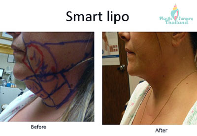 smart-lipo-laser-thailand-before-after-neck-lipo