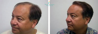pre-wedding-groom-makeover-hair-transplant-thailand