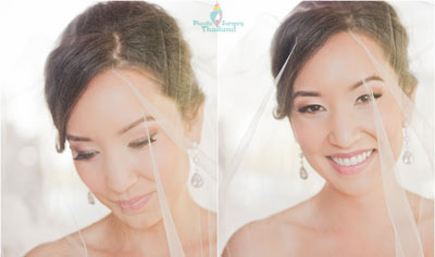 pre-weddings-facelift-makeover