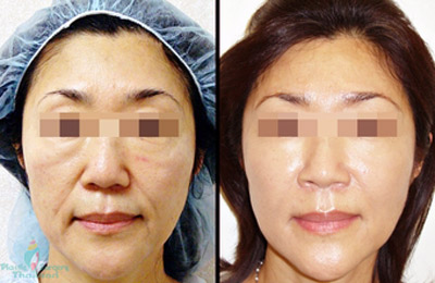 Skin Tightening Kenya, Laser Skin Tightening