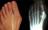 brachymetatarsia-bunion-surgery-thailand-bangkok