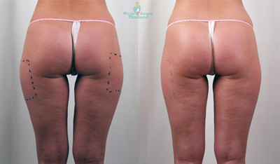 exilis-before-after-thighs-thailand