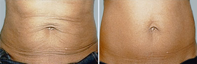 exilis-tummy-before-after-thailand