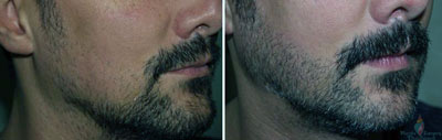 beard-hair-restoration-before-after