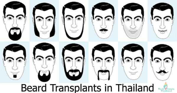 beard-implants-thailand-goatee-sideburns