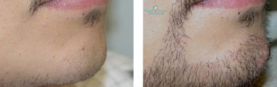 facial-hair-implants-before-after