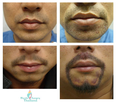 Facial Hair Grafting Beard Hair Transplants Goatee Sideburns Mustache Page 2 Aesthetic Surgery Center Of Thailand